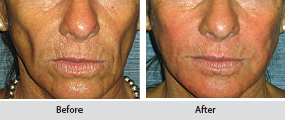 radiesse dermal filler, before and after images
