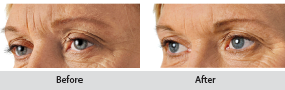 restylane dermal filler, before and after images