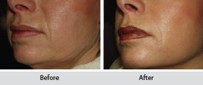 sculptra dermal filler, before and after images