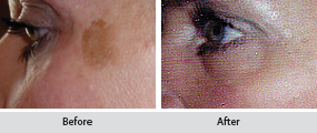 chemical peels, before and after images