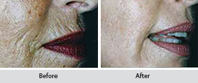 the liquid facelift, before and after images