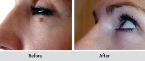 moles and skin tags removal, before and after images