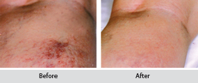 sclerotherapy thread vein removal, before and after images