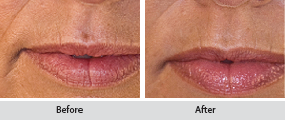 juvederm dermal filler, before and after images